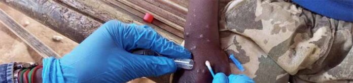 Monkeypox