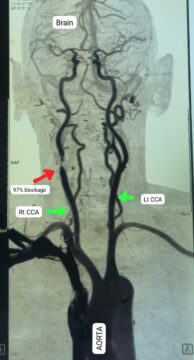 Carotid Endarterectomy Surgery