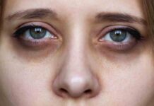 डार्क सर्कल्स : आंखों के आसपास के ये काले घेरे शारीरिक थकान का भी देते हैं संकेत Dark Circles eyes how