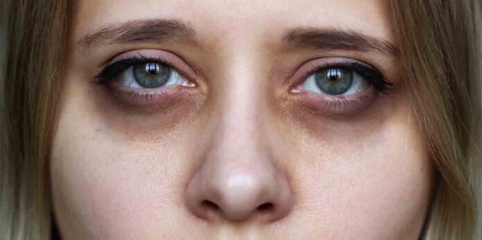 Dark Circles eyes how Dark Circles eyes how