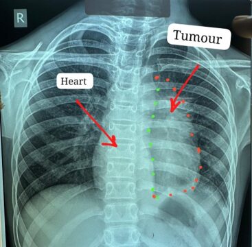 Big Cancer Operation Sucssefully Done at JNM