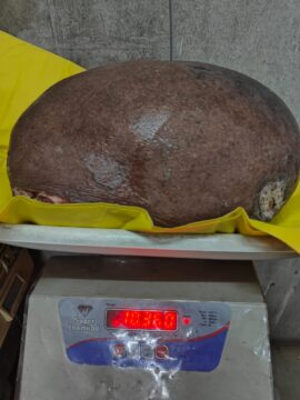 Big Tumor Operation Done by Ambedkar Hospital