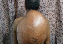 अम्बेडकर अस्पताल के सर्जरी विभाग की ऐतिहासिक उपलब्धि :10.30 किलोग्राम वजनी विशाल ट्यूमर का सफल ऑपरेशन Big Tumor Operation Done by Ambedkar Hospital